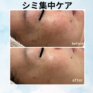 【2Fエアリアル】悩み続けていたシミを改善！