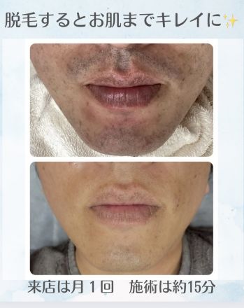 【2Fエアリアル】お肌までキレイに！メンズヒゲ脱毛！