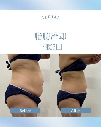 大人気の脂肪冷却