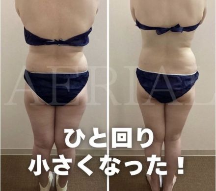 【エアリアル】今流行りの脂肪冷却！